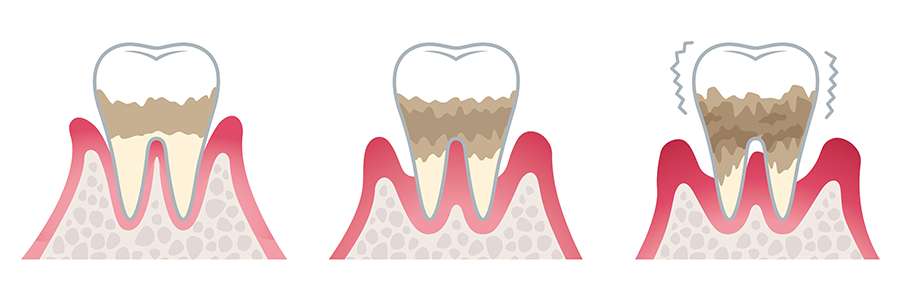 歯槽膿漏？歯周病？似た名前が多くて混乱していませんか？